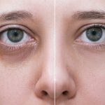 Sposoby na podkrążone oczy – poznaj praktyczne porady